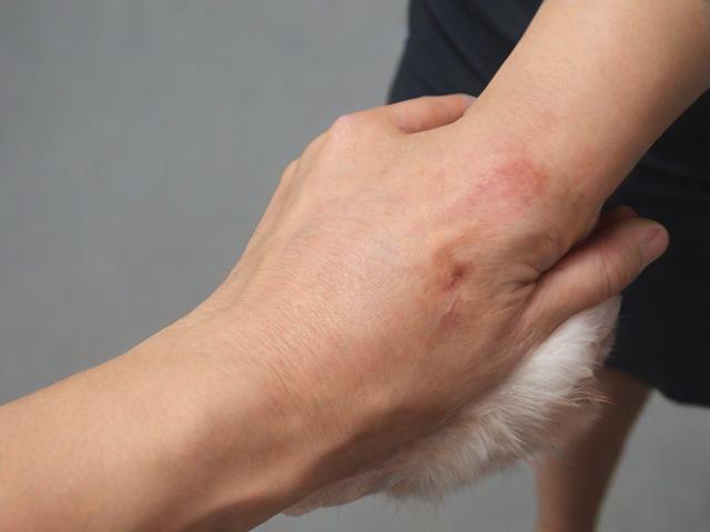 芜湖狐臭治疗哪里好？芜湖专业狐臭医院推荐指南